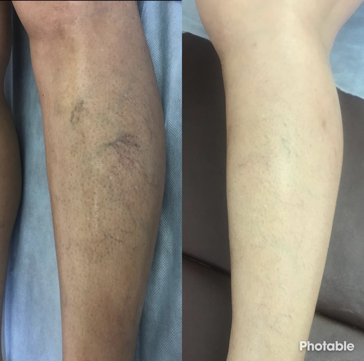 Before and after — Sclerotherapy result for Ahmed K.