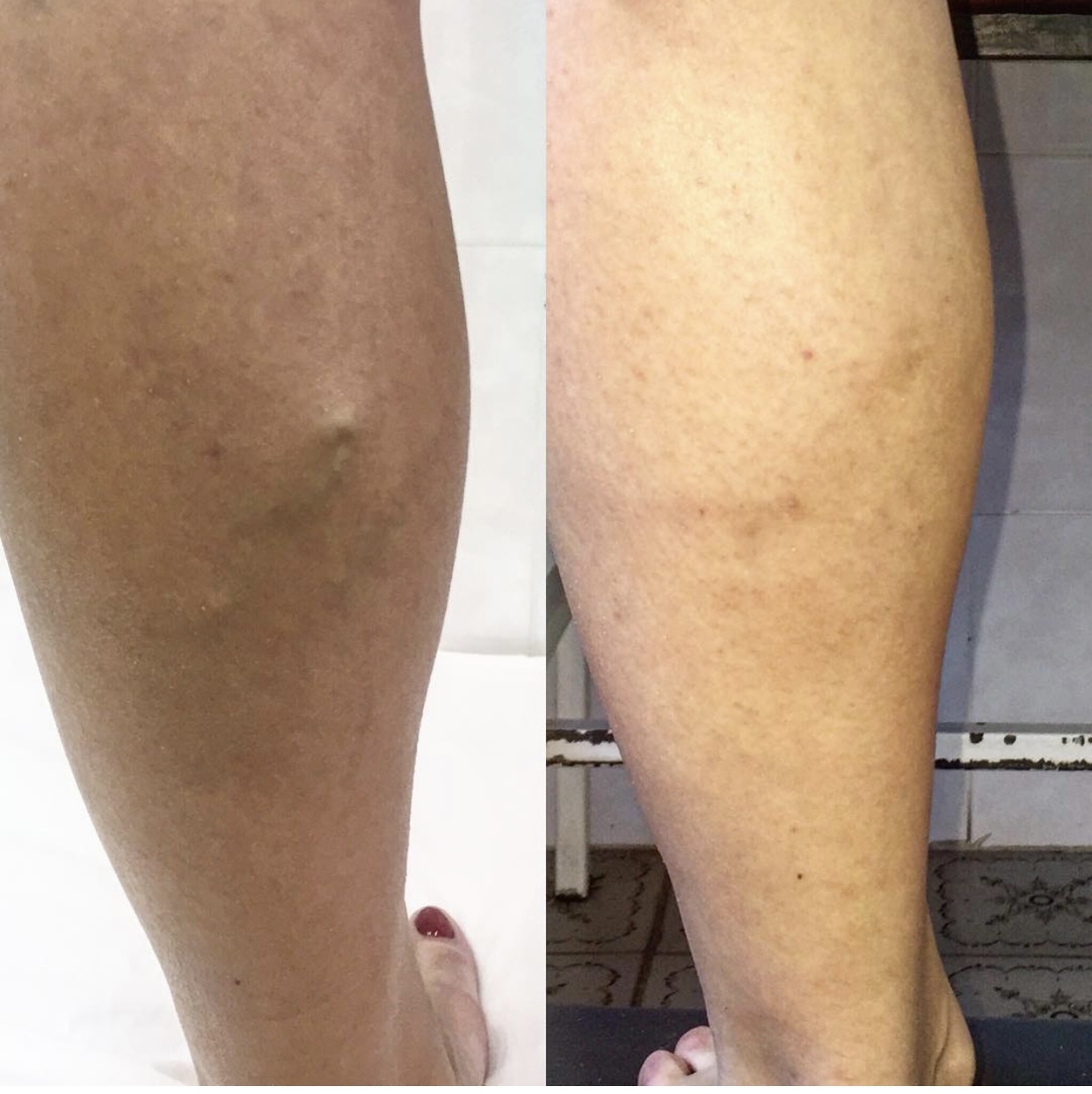 Before and after — Spider Vein Treatment result for Elena R.