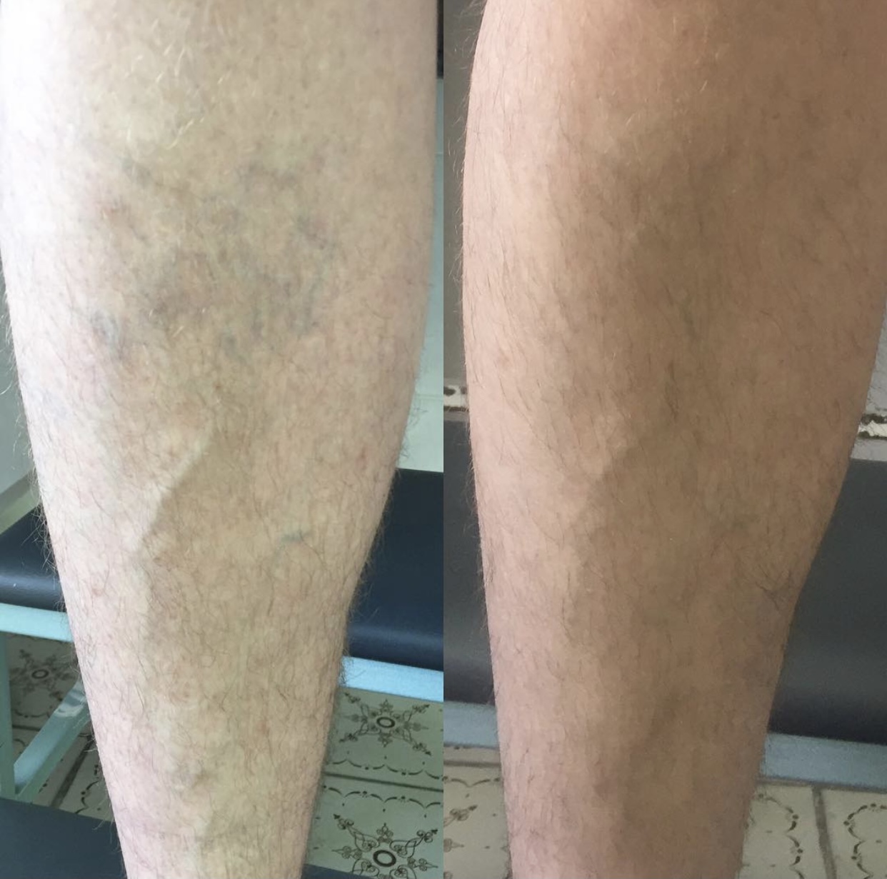 Before and after — Foam Sclerotherapy result for Marco T.