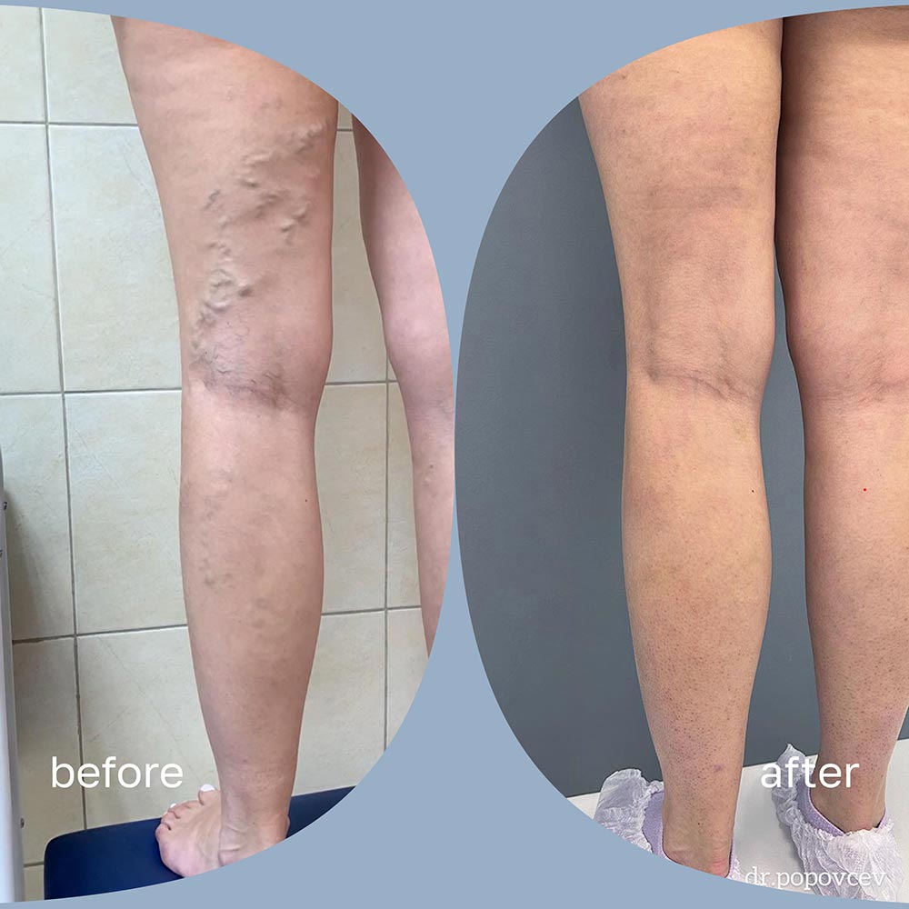 Before and after — EVLA Laser result for Sarah M.