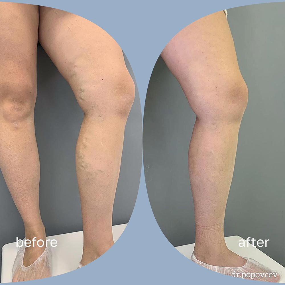 Before and after — RFA + Sclerotherapy result for Olga V.